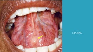 LIPOMA
 