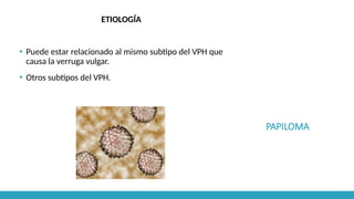 PAPILOMA
ETIOLOGÍA
▪ Puede estar relacionado al mismo subtipo del VPH que
causa la verruga vulgar.
▪ Otros subtipos del VPH.
 