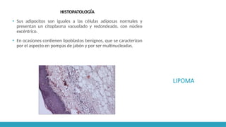 LIPOMA
HISTOPATOLOGÍA
▪ Sus adipocitos son iguales a las células adiposas normales y
presentan un citoplasma vacuolado y redondeado, con núcleo
excéntrico.
▪ En ocasiones contienen lipoblastos benignos, que se caracterizan
por el aspecto en pompas de jabón y por ser multinucleadas.
 