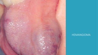 HEMANGIOMA
 
