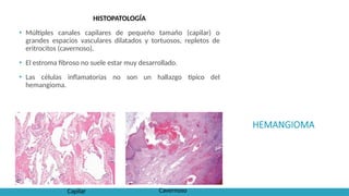 HEMANGIOMA
HISTOPATOLOGÍA
▪ Múltiples canales capilares de pequeño tamaño (capilar) o
grandes espacios vasculares dilatados y tortuosos, repletos de
eritrocitos (cavernoso).
▪ El estroma fibroso no suele estar muy desarrollado.
▪ Las células inflamatorias no son un hallazgo típico del
hemangioma.
Capilar Cavernoso
 