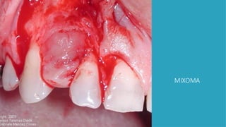 MIXOMA
 