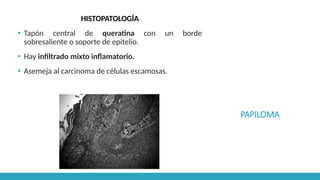PAPILOMA
HISTOPATOLOGÍA
▪ Tapón central de queratina con un borde
sobresaliente o soporte de epitelio.
▪ Hay infiltrado mixto inflamatorio.
▪ Asemeja al carcinoma de células escamosas.
 
