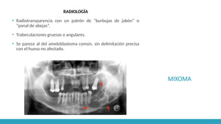 MIXOMA
RADIOLOGÍA
▪ Radiotransparencia con un patrón de “burbujas de jabón” o
“panal de abejas”.
▪ Trabeculaciones gruesas o angulares.
▪ Se parece al del ameloblastoma común, sin delimitación precisa
con el hueso no afectado.
 