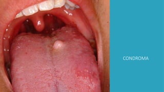 CONDROMA
 