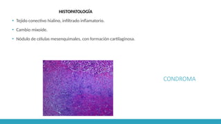 CONDROMA
HISTOPATOLOGÍA
▪ Tejido conectivo hialino, infiltrado inflamatorio.
▪ Cambio mixoide.
▪ Nódulo de células mesenquimales, con formación cartilaginosa.
 
