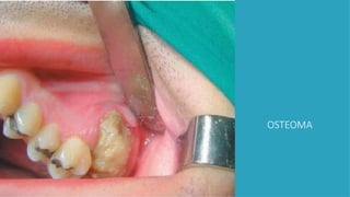 OSTEOMA
 