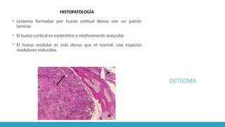OSTEOMA
HISTOPATOLOGÍA
▪ Lesiones formadas por hueso cortical denso con un patrón
laminar.
▪ El hueso cortical es esclerótico y relativamente avascular.
▪ El hueso medular es más denso que el normal, con espacios
medulares reducidos.
 