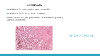 OSTEOMA OSTEOIDE
HISTOPATOLOGÍA
▪ Osteoblastos depositan amplias zonas de osteoide.
▪ Osteoide calcificado, forma atípica de hueso.
▪ Centro vacularizado, con gran número de osteoblastos gruesos y
grandes osteoclastos.
 