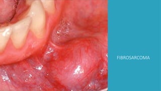 FIBROSARCOMA
 