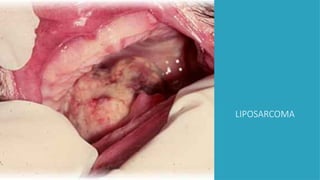LIPOSARCOMA
 