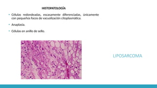 LIPOSARCOMA
HISTOPATOLOGÍA
▪ Células redondeadas, escasamente diferenciadas, únicamente
con pequeños focos de vacuolización citoplasmática.
▪ Anaplasia.
▪ Células en anillo de sello.
 