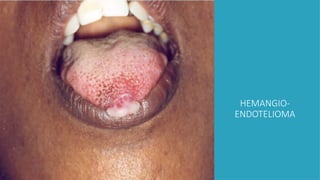 HEMANGIO-
ENDOTELIOMA
 