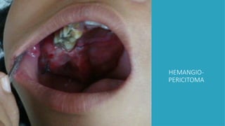 HEMANGIO-
PERICITOMA
 