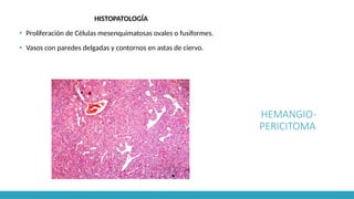 HEMANGIO-
PERICITOMA
HISTOPATOLOGÍA
▪ Proliferación de Células mesenquimatosas ovales o fusiformes.
▪ Vasos con paredes delgadas y contornos en astas de ciervo.
 