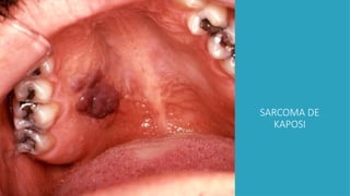SARCOMA DE
KAPOSI
 