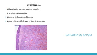 SARCOMA DE KAPOSI
HISTOPATOLOGÍA
▪ Células fusiformes con aspecto blando.
▪ Eritrocitos extravasados.
▪ Asemeja al Granuloma Piógeno.
▪ Aparece Hemosiderina en el Kaposi Avanzado.
 