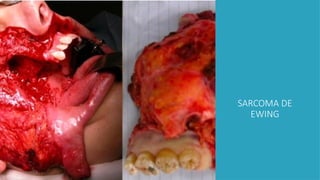 SARCOMA DE
EWING
 