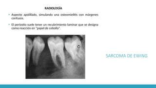 SARCOMA DE EWING
RADIOLOGÍA
▪ Aspecto apolillado, simulando una osteomielitis con márgenes
confusos.
▪ El periostio suele tener un recubrimiento laminar que se designa
como reacción en “papel de cebolla”.
 