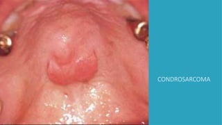 CONDROSARCOMA
 