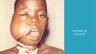 LINFOMA DE
HODGKIN
 