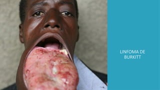 LINFOMA DE
BURKITT
 
