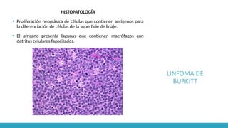 LINFOMA DE
BURKITT
HISTOPATOLOGÍA
▪ Proliferación neoplásica de células que contienen antígenos para
la diferenciación de células de la superficie de linaje.
▪ El africano presenta lagunas que contienen macrófagos con
detritus celulares fagocitados.
 