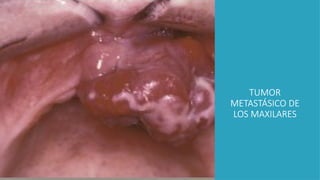 TUMOR
METASTÁSICO DE
LOS MAXILARES
 