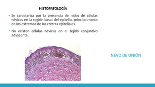 NEVO DE UNIÓN
HISTOPATOLOGÍA
▪ Se caracteriza por la presencia de nidos de células
névicas en la región basal del epitelio, principalmente
en los extremos de las crestas epiteliales.
▪ No existen células névicas en el tejido conjuntivo
adyacente.
 