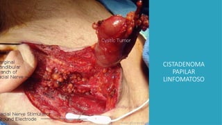 CISTADENOMA
PAPILAR
LINFOMATOSO
 