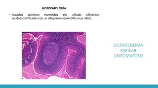 CISTADENOMA
PAPILAR
LINFOMATOSO
HISTOPATOLOGÍA
▪ Espacios quísticos revestidos por células cilíndricas
seudoestratificadas con un citoplasma eosinófilo muy nítido.
 
