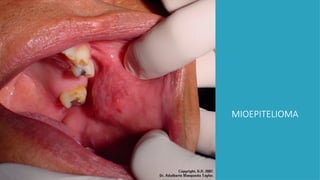 MIOEPITELIOMA
 
