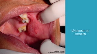 SÍNDROME DE
SJÖGREN
 