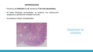 SÍNDROME DE
SJÖGREN
HISTOPATOLOGÍA
▪ Presencia de linfocitos T y B, siendo los T los más abundantes.
▪ Al haber linfocitos aumentados, se produce una destrucción
progresiva y pérdida de unidades acinares.
▪ Se producen islotes mioepiteliales.
 