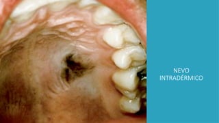 NEVO
INTRADÉRMICO
 