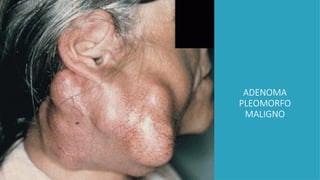 ADENOMA
PLEOMORFO
MALIGNO
 