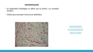 ADENOMA
PLEOMORFO
MALIGNO
HISTOPATOLOGÍA
▪ Su diagnóstico histológico es difícil, por lo similar a su variedad
benigna.
▪ Células que asemejan estructuras epiteliales.
 