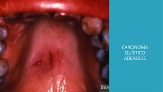 CARCINOMA
QUÍSTICO
ADENOIDE
 