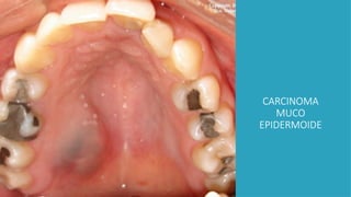 CARCINOMA
MUCO
EPIDERMOIDE
 