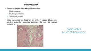 CARCINOMA
MUCOEPIDERMOIDE
HISTOPATOLOGÍA
▪ Presentan 3 tipos celulares predominantes:
▪ Células mucosas
▪ Células epidermoides
▪ Células intermedias
▪ Estos elementos se disponen en nidos y capas difusas que
pueden circundar espacios quísticos. Carecen de cápsula
verdadera.
 