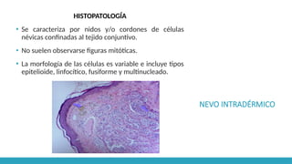 NEVO INTRADÉRMICO
HISTOPATOLOGÍA
▪ Se caracteriza por nidos y/o cordones de células
névicas confinadas al tejido conjuntivo.
▪ No suelen observarse figuras mitóticas.
▪ La morfología de las células es variable e incluye tipos
epitelioide, linfocítico, fusiforme y multinucleado.
 