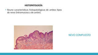NEVO COMPUESTO
HISTOPATOLOGÍA
▪ Reune características histopatológicas de ambos tipos
de nevo (intramucoso y de unión).
 