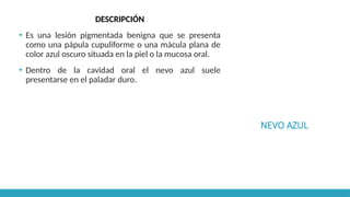 NEVO AZUL
DESCRIPCIÓN
▪ Es una lesión pigmentada benigna que se presenta
como una pápula cupuliforme o una mácula plana de
color azul oscuro situada en la piel o la mucosa oral.
▪ Dentro de la cavidad oral el nevo azul suele
presentarse en el paladar duro.
 