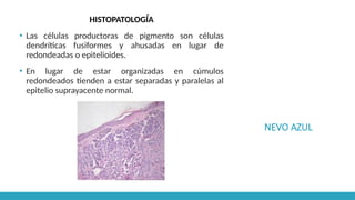 NEVO AZUL
HISTOPATOLOGÍA
▪ Las células productoras de pigmento son células
dendríticas fusiformes y ahusadas en lugar de
redondeadas o epitelioides.
▪ En lugar de estar organizadas en cúmulos
redondeados tienden a estar separadas y paralelas al
epitelio suprayacente normal.
 