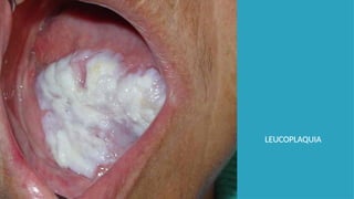 LEUCOPLAQUIA
 