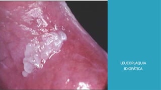 LEUCOPLAQUIA
IDIOPÁTICA
 