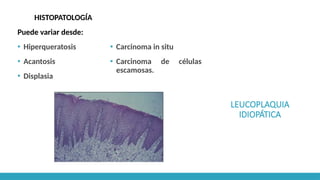 LEUCOPLAQUIA
IDIOPÁTICA
HISTOPATOLOGÍA
Puede variar desde:
▪ Hiperqueratosis
▪ Acantosis
▪ Displasia
▪ Carcinoma in situ
▪ Carcinoma de células
escamosas.
 
