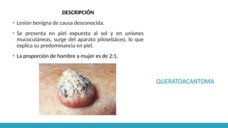 QUERATOACANTOMA
DESCRIPCIÓN
▪ Lesión benigna de causa desconocida.
▪ Se presenta en piel expuesta al sol y en uniones
mucocutáneas, surge del aparato pilosebáceo, lo que
explica su predominancia en piel.
▪ La proporción de hombre a mujer es de 2:1.
 