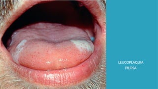 LEUCOPLAQUIA
PILOSA
 