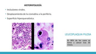 LEUCOPLAQUIA PILOSA
HISTOPATOLOGÍA
▪ Inclusiones virales.
▪ Desplazamiento de la cromatina a la periferia.
▪ Superficie hiperqueratósica.
EL 80% de los casos se
torna a cáncer tras 30
meses.
 